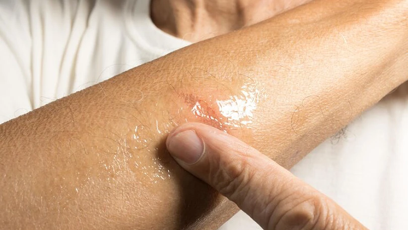 Cilt Yanıklarına Ne İyi Gelir?